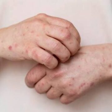 BROTE DE SARAMPIÓN EN MÉXICO: ESTADOS CON MÁS CASOS AL 11 DE FEBRERO DE 2026